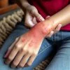 حساسیت به عسل طبیعی:(3 علل، 5 علائم و  5 راه درمان)